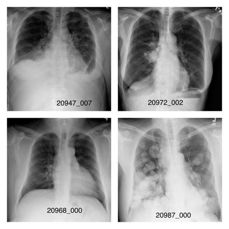 Nih Chest X Ray