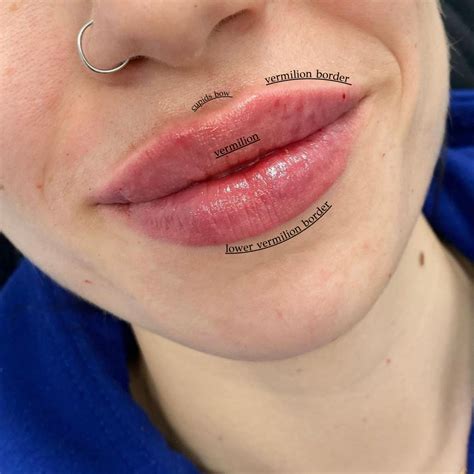 Lip Filler Migration