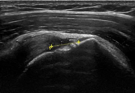 Shoulder Ultrasound