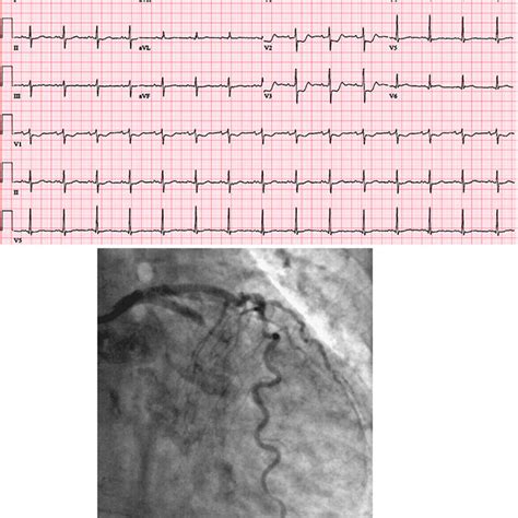 Ecg Of Lmca Occlusion Download Scientific Diagram