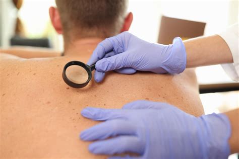 Come Ci Si Accorge Di Avere Un Melanoma 10 Campanelli D Allarme