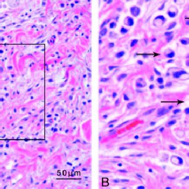 Pathological Examination Of A Biopsy Specimen Of The Subcutaneous