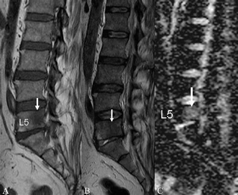 A C Tuberculosis Of Spine Sagittal T1w A And T2w B Images In A