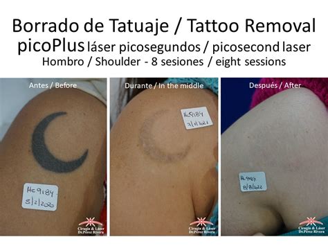 Borrar Tatuaje Con Laser En Buenos Aires CABA Borrar Un Tatuaje