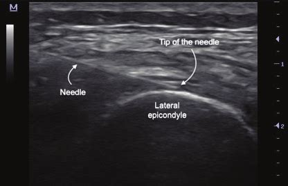 Ultrasound Guided Superior Lateral Genicular Nerve Block Axial Plane