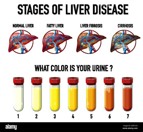 Stages of liver disease Stock Vector Image & Art - Alamy