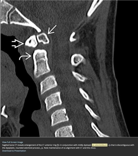 Os odontoideum | Terminale