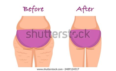 Butt Plumping Over 36 Royalty Free Licensable Stock Illustrations