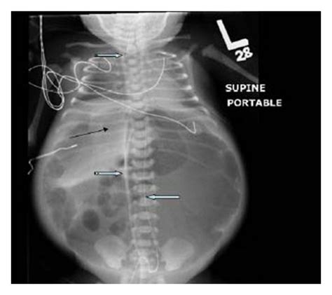 A baby gram X-ray showing a severely distended abdomen with free... | Download Scientific Diagram