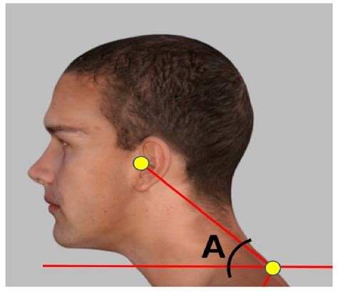 Jcm Free Full Text Two Methods Of Forward Head Posture Assessment Radiography Vs Posture