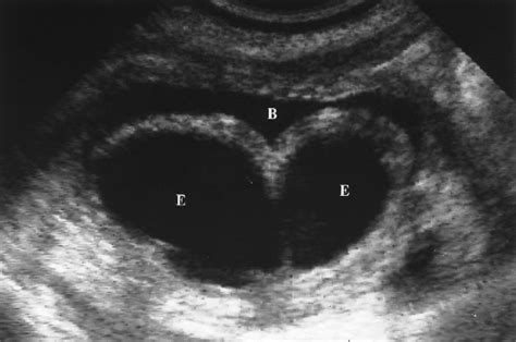 Renal Bladder And Adrenal Ultrasound Ultrasound Sonography Bladder