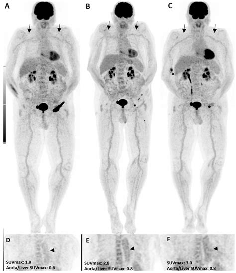 Diagnostics Free Full Text Impact Of 18F FDG PET CT In The