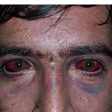 Sub Conjunctival Hemorrhage And Facial Blue Discoloration Starting To