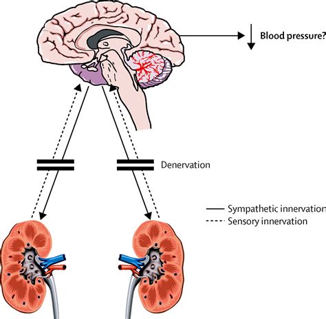 Resistant Hypertension And Renal Denervation 3 Years On The Lancet