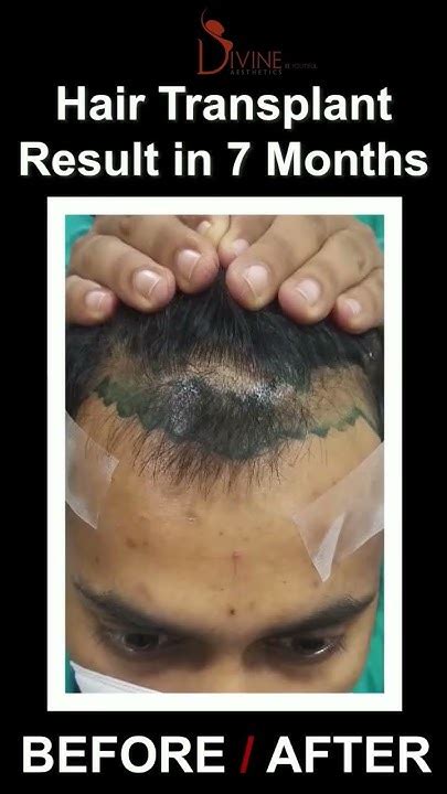 Hair Transplant Results In 7 Months Hair Transplant Results 2022 Hair Transplant New Results