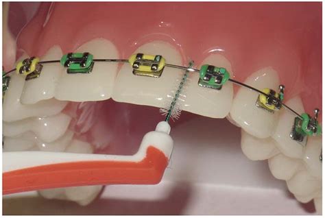 Higiene Bucal Con Ortodoncia Por El Dr Fernando De La Iglesia