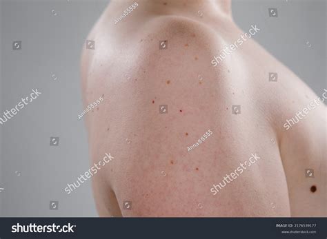 Close Large Moles On Naked Female Stock Photo 2176539177 Shutterstock