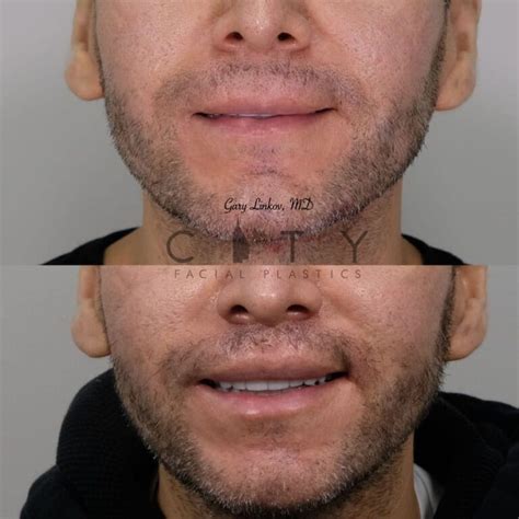 Elelyft Upper Lip Lift Dr Gary Linkov Facial Plastic Surgeon New York