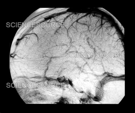 Photograph | Dural Sinus Thrombosis | Science Source Images