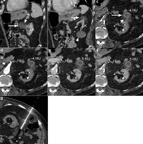 Case 4 CT images. a Sagittal nephrographic phase CT image demonstrating ...