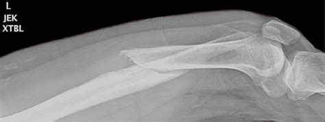 Femur x-ray showing the distal displaced femoral fracture (view 1) | Download Scientific Diagram