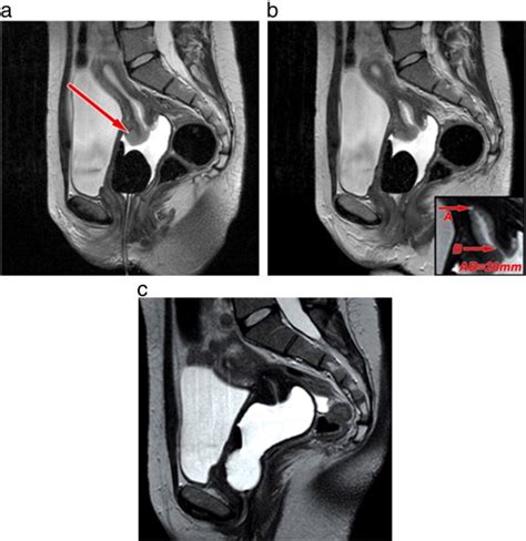 Neoadjuvant Chemotherapy And Vaginal Radical Trachelectomy For