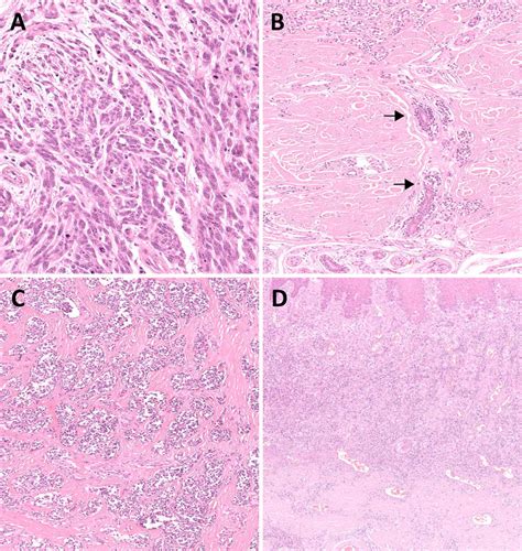 Acral Lentiginous Melanoma A Tumour Cells Are Usually Spindle B