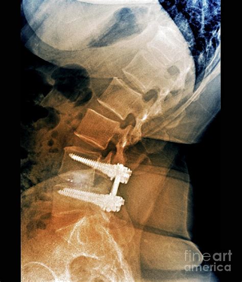 Treatment Of Spinal Disc Herniation Photograph by Zephyr/science Photo Library