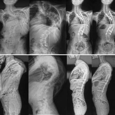 A 19 Year Old Male With Early Onset Idiopathic Scoliosis The Initial