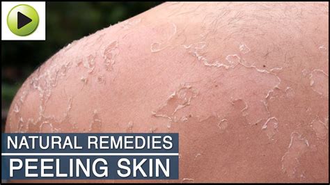 How To Cure Peeling Skin Battlepriority6