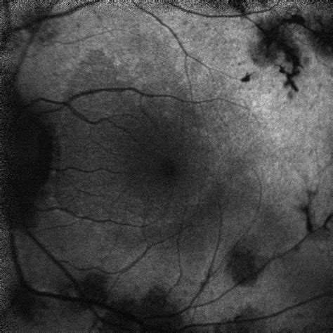 Moran CORE Pigmented Paravenous Retinochoroidal Atrophy