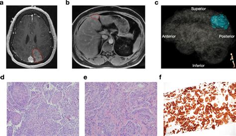 Pre Operative Magnetic Resonance Imaging And Histopathology Of