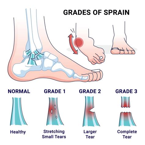 Physical Therapy For Sprained Ankle