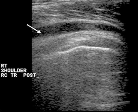 Subdeltoid Bursitis Ultrasound