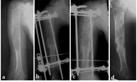 ray  unicameral bone cyst ubc   humerus