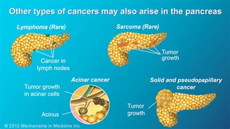 Pancreatic Cancer Pathophysiology Diagnosis And Staging