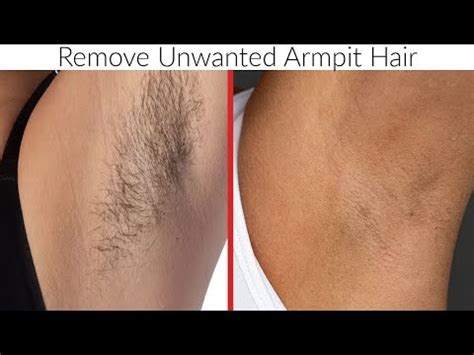 In Just Minutes Permanently Remove Unwanted Armpit Hair From First