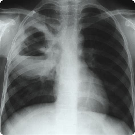 Absceso pulmonar Cirugía Torácica Pediátrica