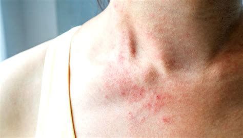 Photosensitivity| Symptoms Causes Types | OnlyMyHealth