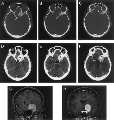 Anterior Clinoid Meningioma Axial Computed Tomographic Images With Download Scientific Diagram