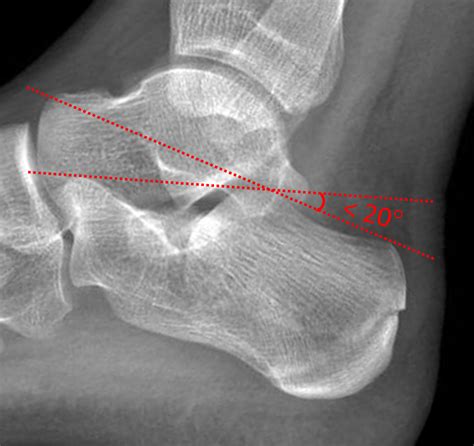 Calcaneal Fracture Angle