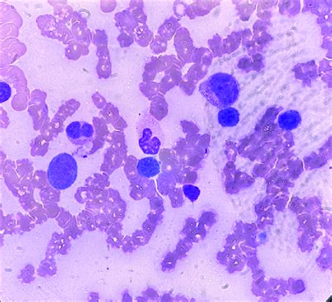 Bone Marrow Biopsy Hematoxylin And Eosin Staining Power Of