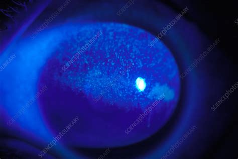 Keratitis Fluorescein Imaging Stock Image C0345811 Science Photo Library