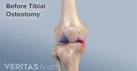 Knee Osteotomy Risks and Complications | Knee osteoarthritis, Knee ...