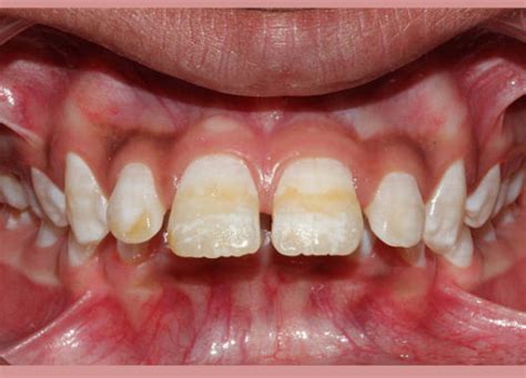 Black Stains On Teeth Causes Remedies And Treatment