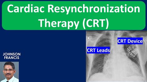 Cardiac Resynchronization Therapy Crt Youtube