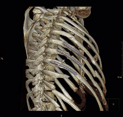 Postoperative D Reconstruction Of Ct Scan At Year Follow Up