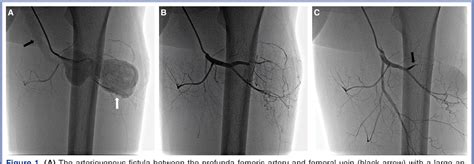 Figure From Coil Embolization Of A Traumatic Arteriovenous Fistula Of