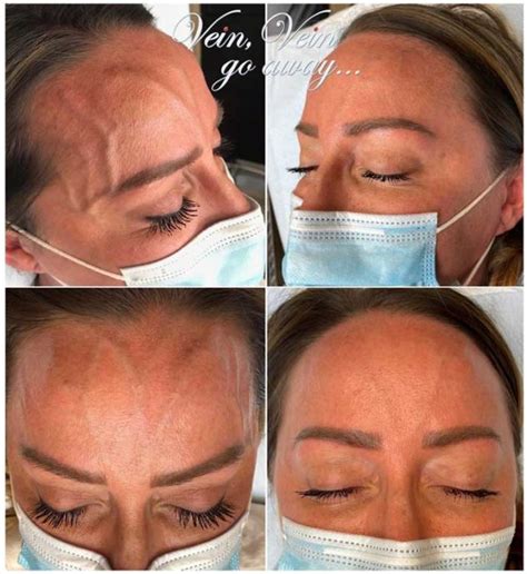 Facial Sclerotherapy Orange County Newport Beach