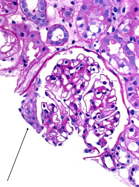 Crescents American Society Of Pediatric Nephrology Aspn